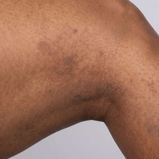 Inner knee and thigh before - darkened friction pigmentation