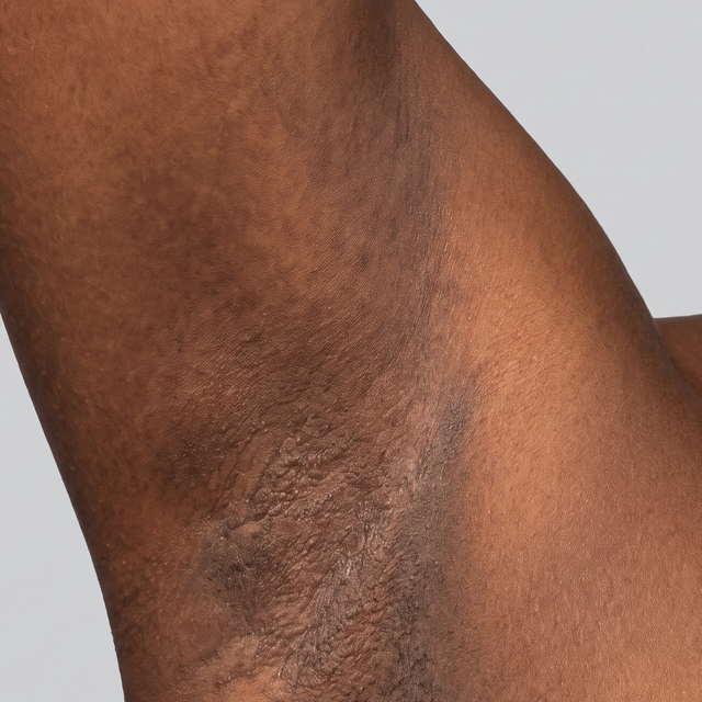 Underarm before - darkened pigmentation on melanin-rich skin